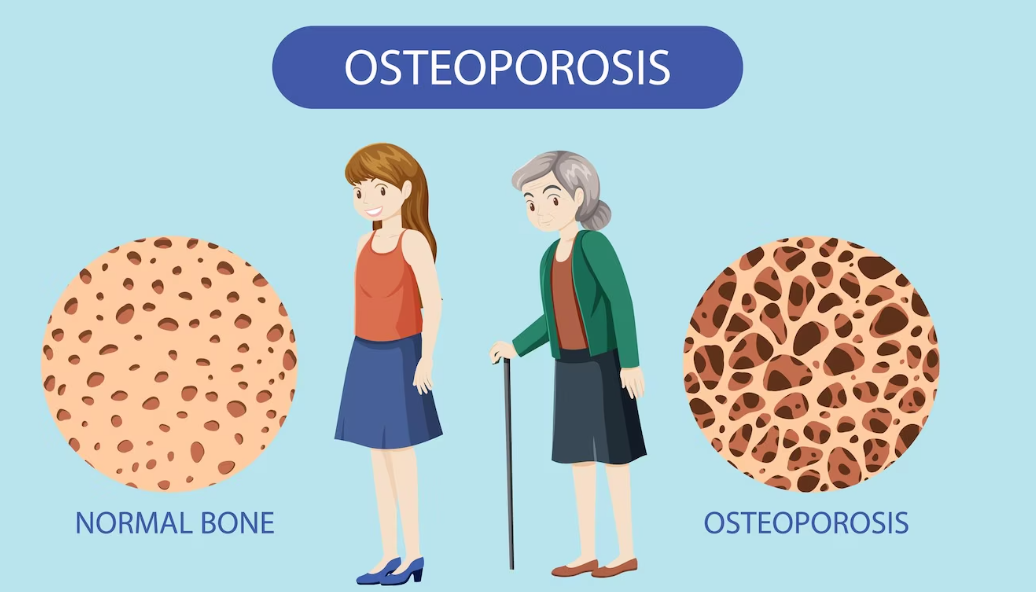 Mengenal Osteoporosis - Faktor Yang Mempengaruhi Penurunan Masa Tulang