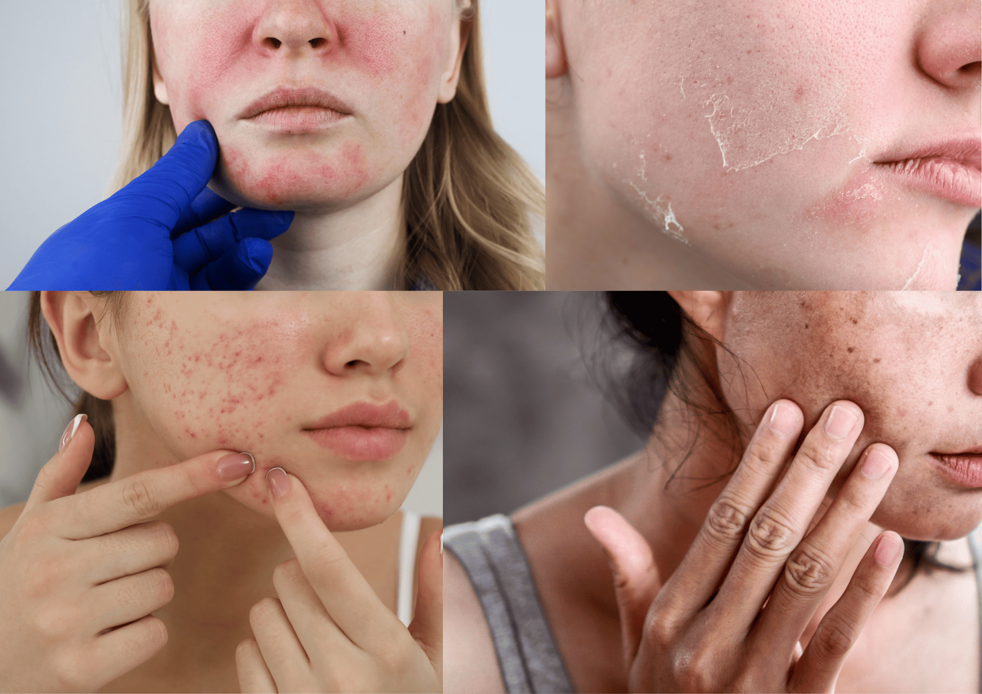 Kulitmu Berjerawat Setelah Skincare? Mungkin Kamu Gak Cocok, Ini Tanda-tandanya