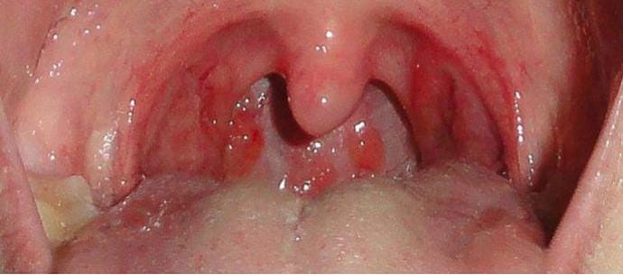 7 Cara Alami Meredakan Radang Tenggorokan dengan Bahan di Dapur