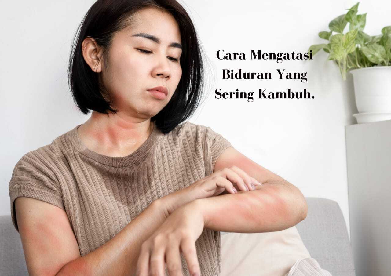 Biduran Suka Tiba-Tiba Kambuh? Beberapa Obat Herbal Ini Bisa Jadi Alternatif Mengobatinya