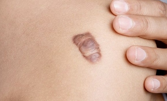 Luka Sudah Sembuh, Tapi Bekasnya Malah Makin Tebal? Kenalan dengan Keloid