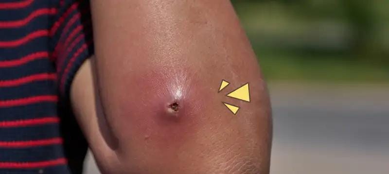 Jangan Dipencet! Cara Aman Mengobati Bisul di Rumah Agar Tidak Infeksi