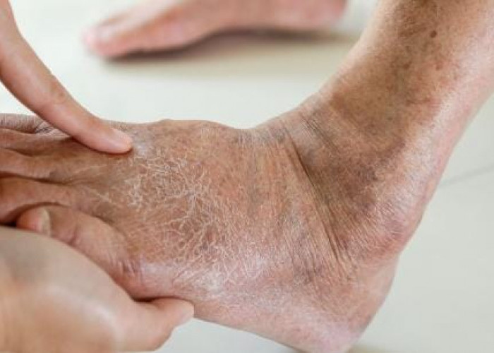 Stop! Gula: Kenikmatan di Lidah yang Harus Dibayar Mahal oleh Darah