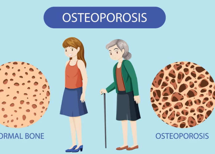 Mengenal Osteoporosis - Faktor Yang Mempengaruhi Penurunan Masa Tulang