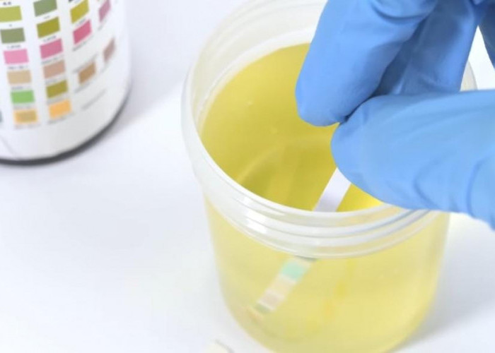 Warna Urin Pekat Saat Puasa Bikin Panik? Ini Penjelasan Medis Lengkap dari Dokter Saddam Ismail