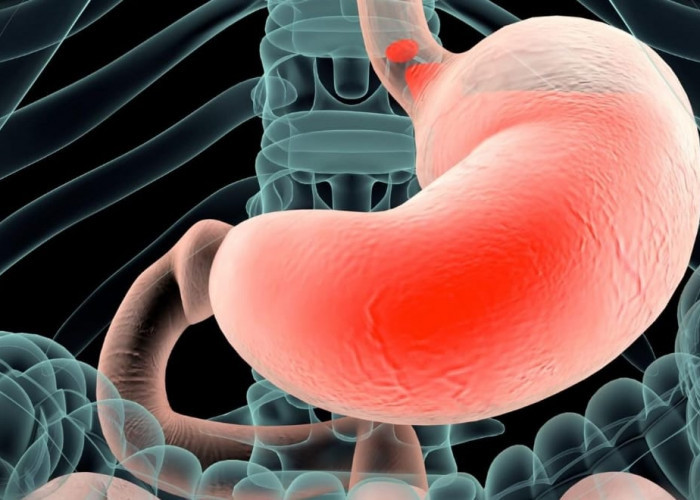 Pertolongan Pertama Saat Asam Lambung Naik: Lakukan 5 Hal Ini Segera