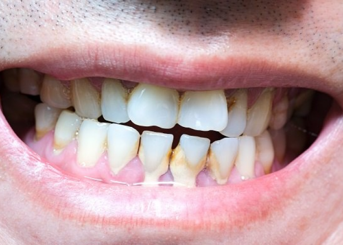 Kamu Punya Karang Gigi? Ini Dia Rahasia Alami Cara Mengatasi Karang Gigi Tanpa Kedokteran