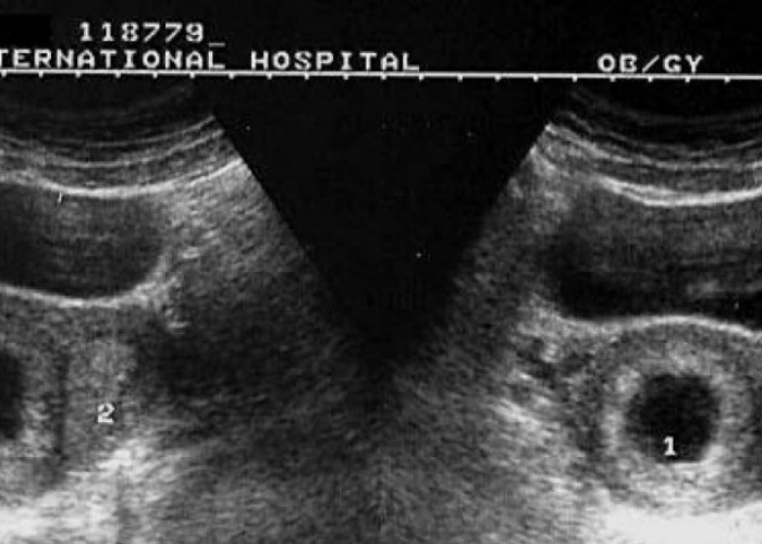 Hidung Ayah atau Mata Ibu? Mengungkap Teka-Teki Wajah Si Kecil Lewat Keajaiban USG AI 2026