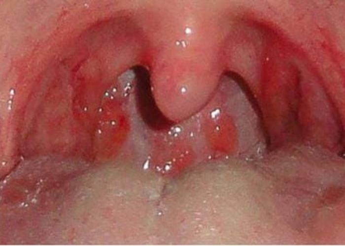 7 Cara Alami Meredakan Radang Tenggorokan dengan Bahan di Dapur