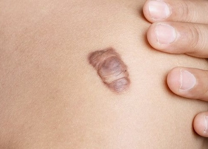 Luka Sudah Sembuh, Tapi Bekasnya Malah Makin Tebal? Kenalan dengan Keloid