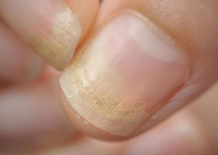 Waspada! 9 Tanda Awal Penyakit Ginjal yang Bisa Terlihat dari Kulit, Banyak Orang Tak Menyadarinya