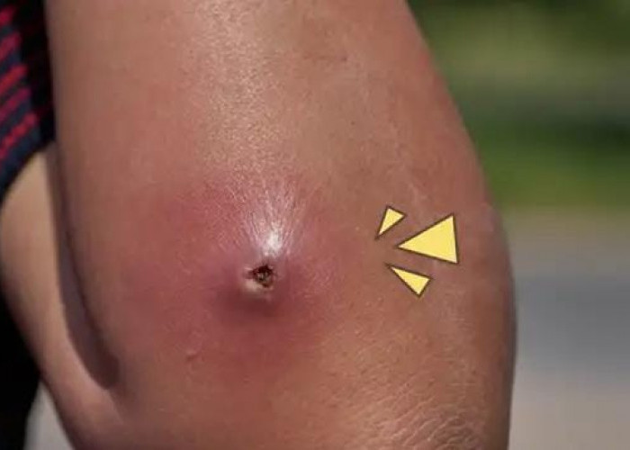 Jangan Dipencet! Cara Aman Mengobati Bisul di Rumah Agar Tidak Infeksi