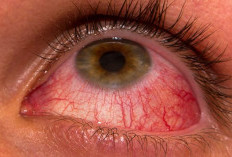 Sering Sakit Mata? Bisa Jadi Kebiasaan Sepele Ini Penyebabnya!