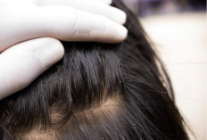 Cara Ampuh Menghilangkan Kutu Rambut Menurut Dokter: Dari Sisir Serit hingga Obat Permetrin