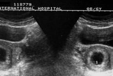 Hidung Ayah atau Mata Ibu? Mengungkap Teka-Teki Wajah Si Kecil Lewat Keajaiban USG AI 2026