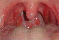 7 Cara Alami Meredakan Radang Tenggorokan dengan Bahan di Dapur