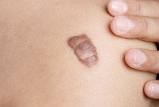 Luka Sudah Sembuh, Tapi Bekasnya Malah Makin Tebal? Kenalan dengan Keloid