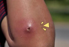 Jangan Dipencet! Cara Aman Mengobati Bisul di Rumah Agar Tidak Infeksi