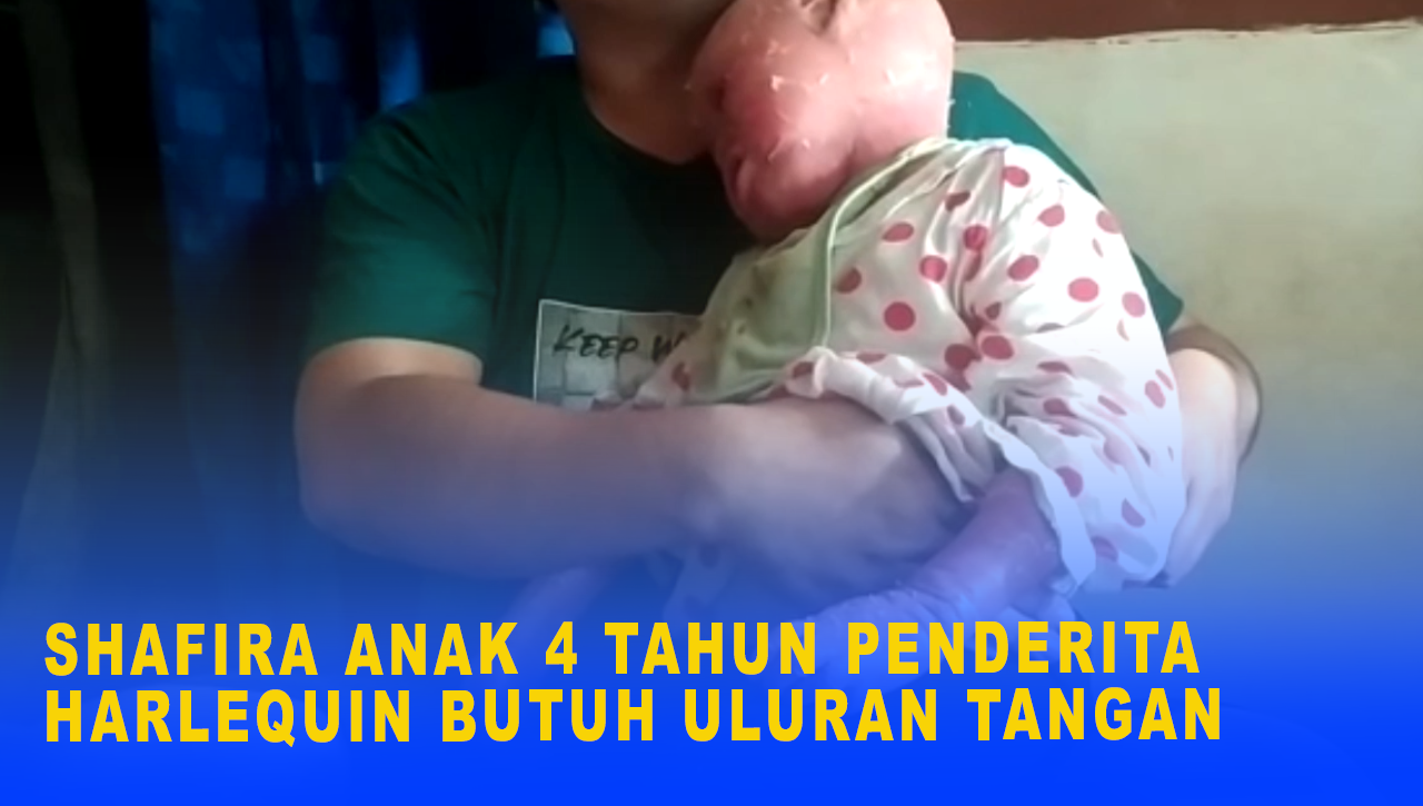 SHAFIRA ANAK 4 TAHUN PENDERITA HARLEQUIN BUTUH ULURAN TANGAN